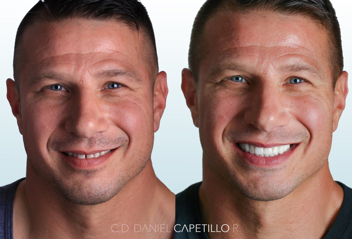 Before and after of a veneers case by Dr. Daniel Capetillo
