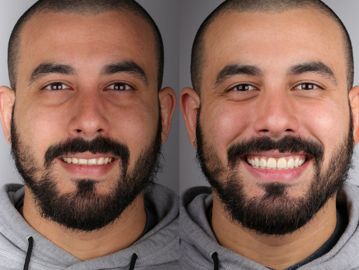 Before and after of a veneers case by Dr. Daniel Capetillo