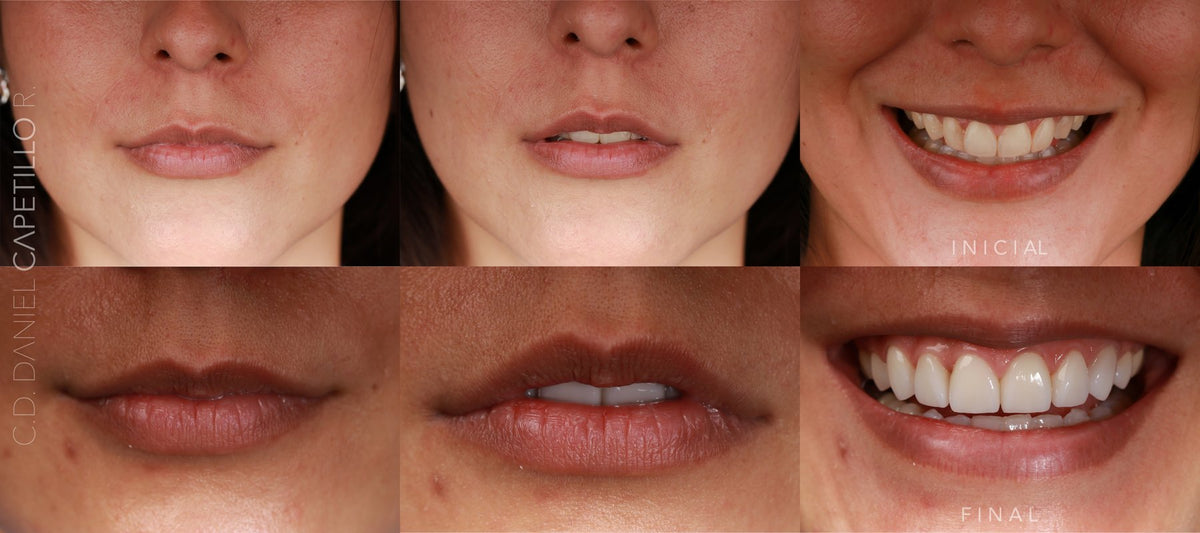 Before and after of a veneers case by Dr. Daniel Capetillo